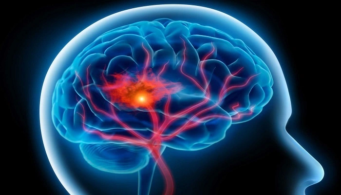 کاردرمانی برای بیماران سکته مغزی